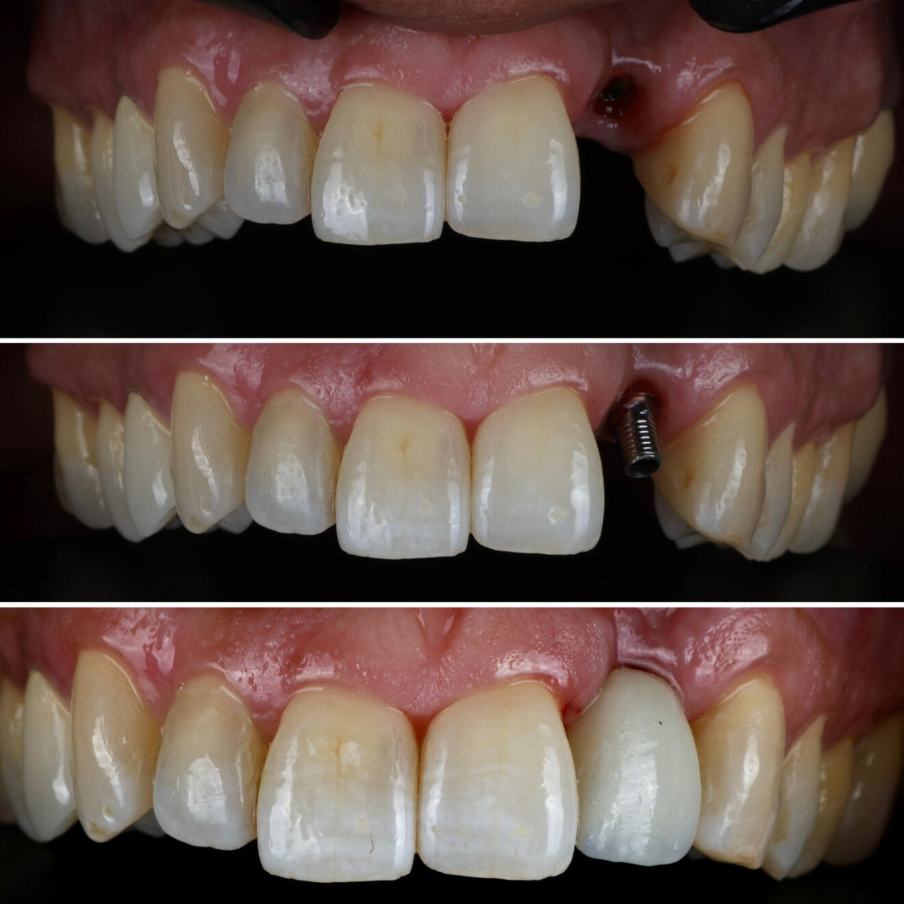 Teeth implant Teeth implant