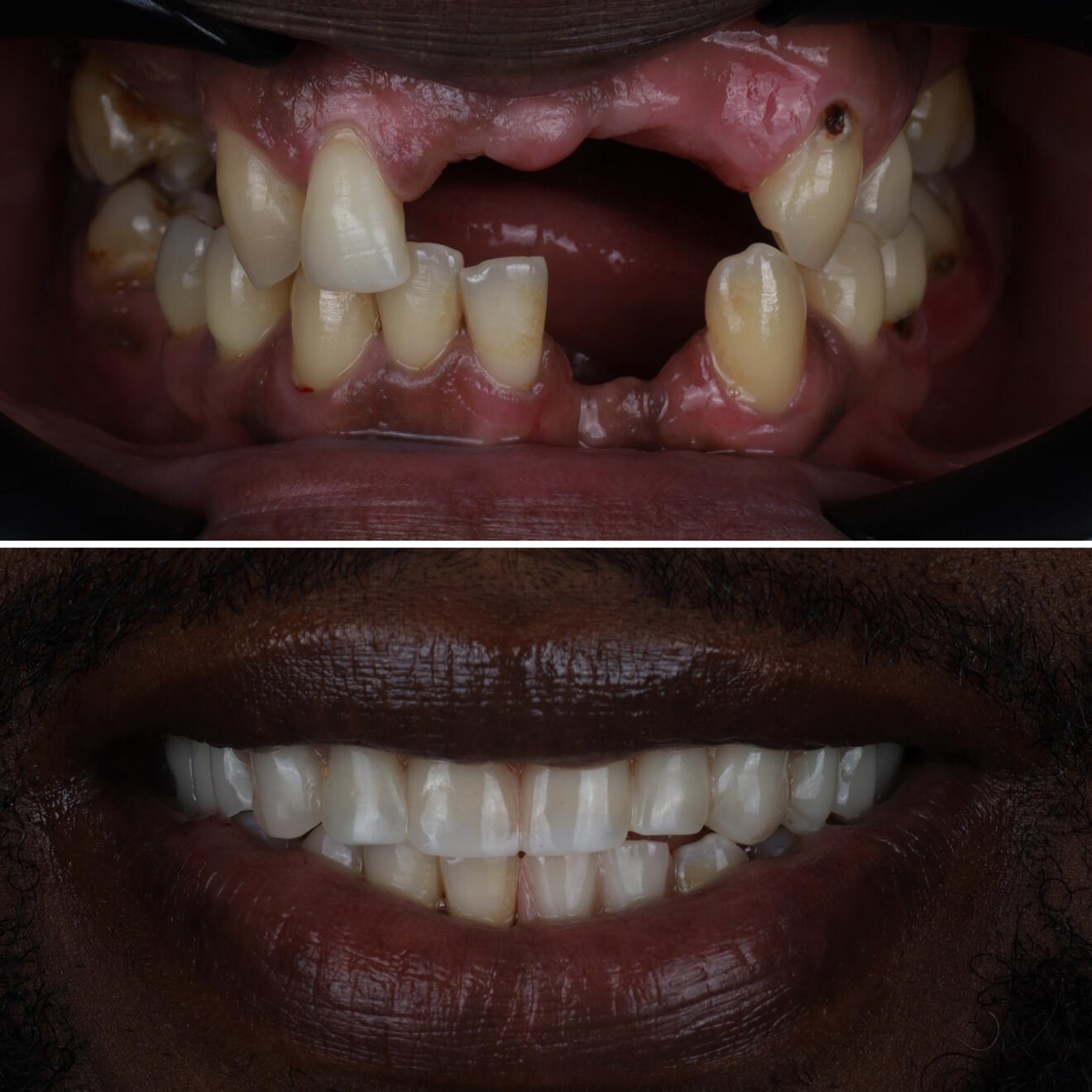 Full arch before and after Full arch before and after