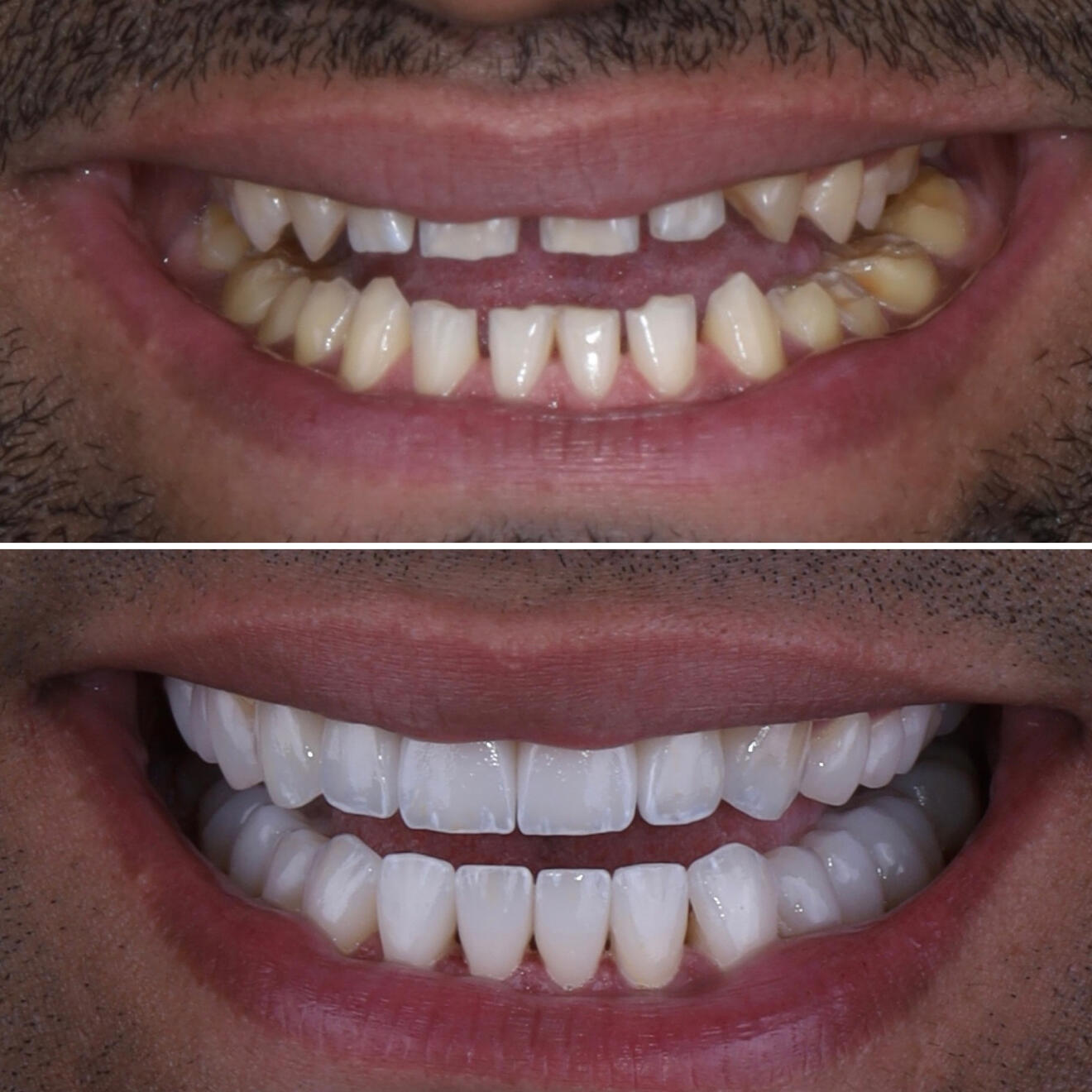 Smile design Smile design